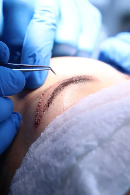 Eyebrow Restoration