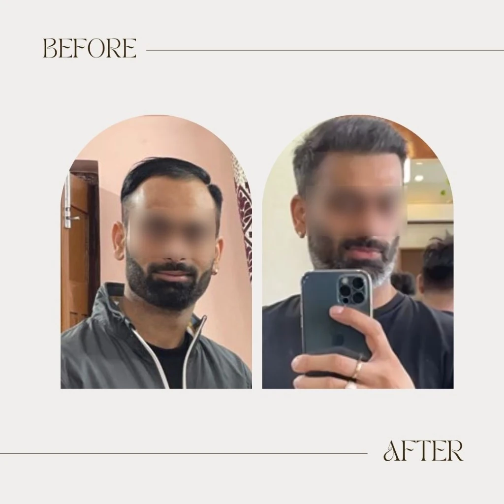 DHI — 3200 Grafts